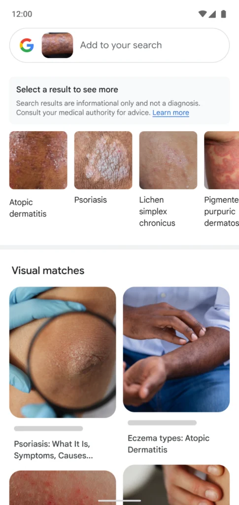 Google Lens giờ đây có thể tìm kiếm các bệnh về da